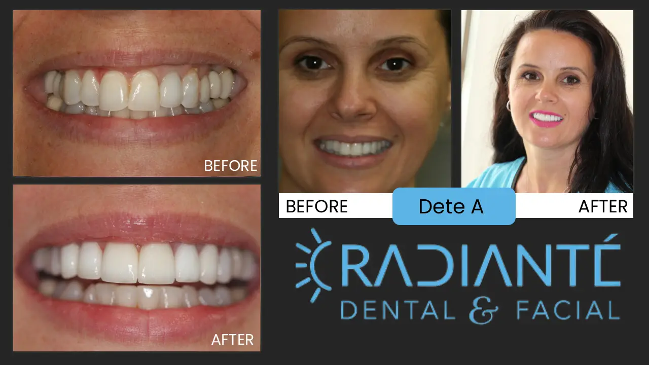 Dete comes to us from Eastern Europe and with some of the dental problems we so often see from these patients.  Not only is she
beautiful, but she is one of the most outstanding cosmetic auxiliaries ever, working with us to help people protect their dental
and facial beauty, perhaps our two best assets.
So as a cosmetic expert, she felt her smile has to represent what we do very well.
She has a really good base to start with because of those long front teeth. We knew if we could resurface and realign these teeth,
they would just look fabulous. Sure enough, she loves how her teeth represent her and show up demonstrably more beautiful than all
her friends in pictures.  So when we talk to patients about cosmetic dentistry and facial esthetics, she is so passionate about
helping patients look and feel their best.  Congrats Dete!