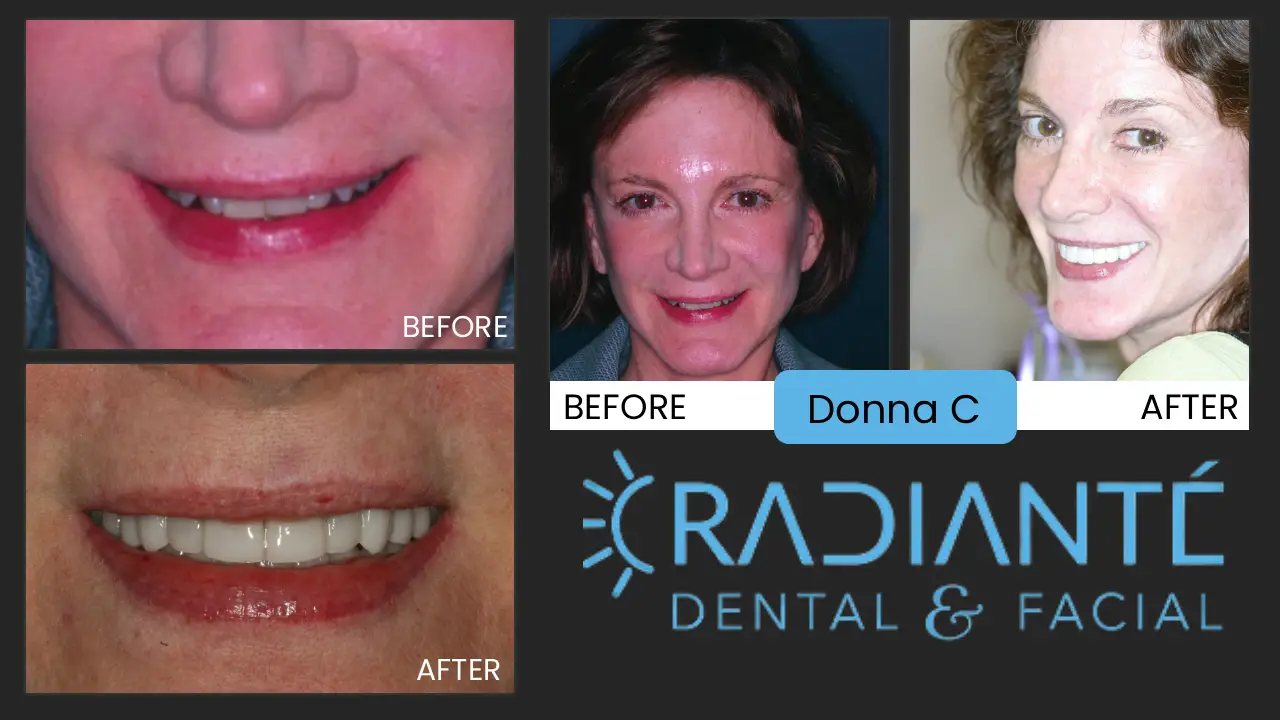 Donna's smile didn't look as great as she felt. She   What we Found: A Shortened space between the tip of the nose and the chin because of worn done teeth. Donna's smile was lost to the eye because of shorter teeth.  What we did: We brought back Donna's smile to a fuller, more youthful, sexiness and elegance to the smile. Now that's something new...your teeth can make you sexier and more elegant?  Absolutely!  Just look at how great Donna now looks not to mention how she feels!
