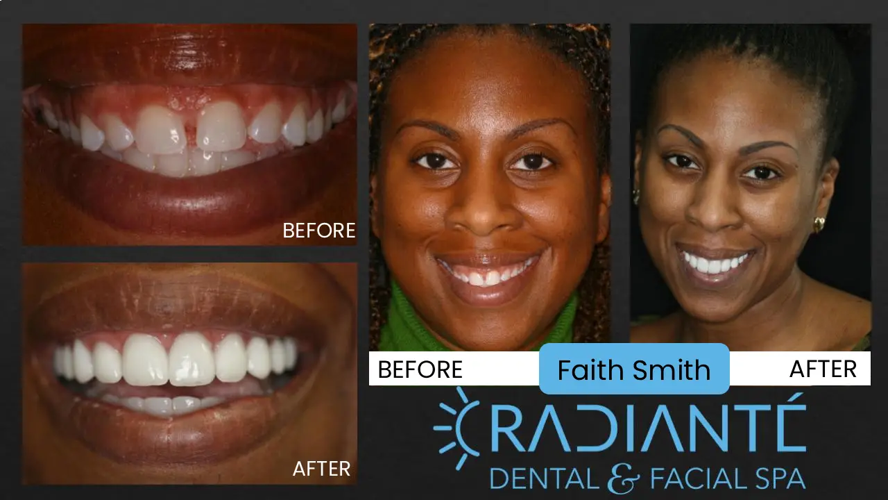 This is a very well educated, beautiful, tall and overall impressive woman on her way up the corporate ladder.  Her smile should match her success and beauty.  She presented with a really big smile, but her teeth and smile  just didn't look right.  She had a very gummy smile with small teeth that just didn't fit a successful, attractive  lady.  Faith found us years ago and we did some things that improved her smile over the years, that she was very  Satisfied with.  As Faith became more successful, she wanted her smile to reflect her success and position  in the working world.  Like so often, we did a gum lift and if you want a more dramatic improvement in your  smile, only veneers can give you that level of improvement.  With her veneers, her smile now looks not only  fabulous, but gives her the impression she was hoping for. Interestingly, Faith gave us a photo of an enter-  tainment star she wanted her smile to emulate.  She was ecstatic when someone recently said she looked like   this entertainer.  Take a look for yourself the wonderful transformation that has taken place. She officially  is also the only photoshoot shot in the snow!