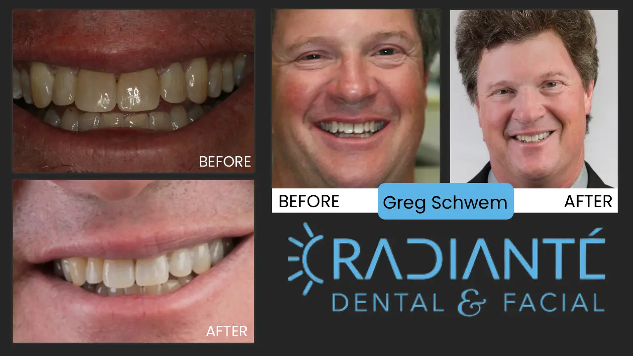 Greg is an author of "Text Me!", executive and corporate speaker and entertainer.
He felt self-conscious about his irregular smile with his "fangs" and gaps.
We did a combination of small, but effective treatments including bonding and recontouring
to give him a smile that is more contiguous.  He is very satisfied and has even done 
commercials for Dr. Ivan to thank him for his "mini smile-makeover!" Greg and his wife Sue are now both on our "Wall Of Fame!"