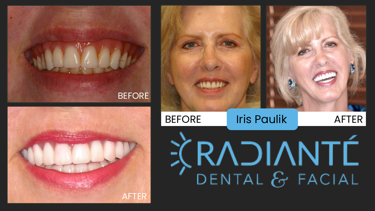 Iris is beautiful, but she just wasn't happy with the smile a dentist had recently made for her.  After listening to her desires, Dr. Ivan found that Iris was unhappy with how gummy her smile looked.
What Dr. Ivan found:  all too common in orthodontics as well, dentists try to align the upper and lower teeth together to make them look straight.  The problem is that Iris has an overbite and by aligning her upper and lower teeth together creates the gumminess.
As with most overbites, it's not the upper teeth that are the problem, it's the lower jaw that doesn't develop far enough forward.
What we did:  In creating this full mouth rehabilitation, Dr. Ivan first created the ideal upper teeth to where Iris was very excited about the aesthetics.  He then designed her lower teeth to meet this idealized look and voila!   An excited and beautiful smile for a beautiful woman!