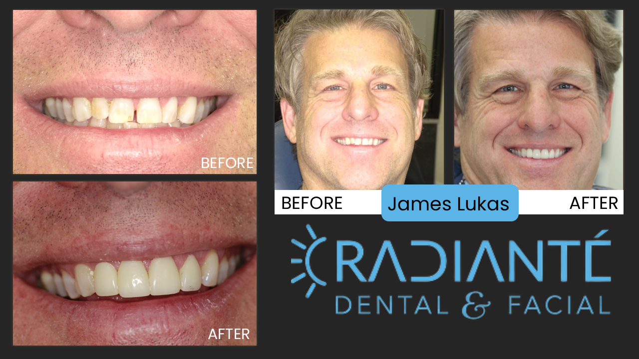 James came to us over a year ago inquiring about veneers for his front teeth/smile.  He was a bit skeptical and busy, so he let it go and now came back and wanted to move forward with the treatment. He loved the way his temporary veneers looked.  And now in his final veneers, he is very happy.  He was astonished how it not only improved the appearance of his front teeth, but also his overall lip and mouth support and facial profile and appearance.  It changed the way he looks for the better.  We got a a 5-star review and his family had all "great reactions."  Congrats James