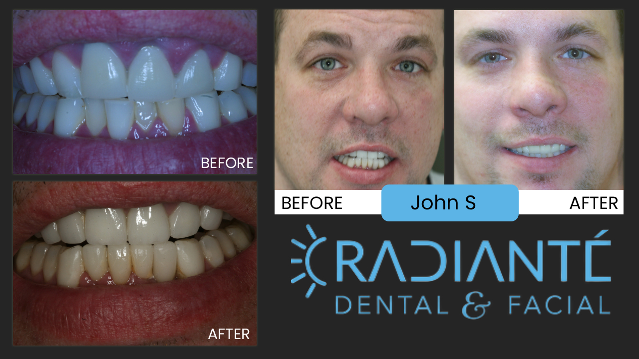 This is a great story. John is a very successful businessman who works with his hands and almost impossible
to get a guy like this to smile! They just aren't used to doing this.
And he feels people and clients might think plumbers are not cultured or "refined."
But John is a guy who invests in Real Estate and collects fine wines and expensive watches and cars.
He felt his smile would convey the message that he may be a guy that works with his hands, but he is 
as savvy and refined as any businessman should be and now has the $1million dollar smile to go with it.