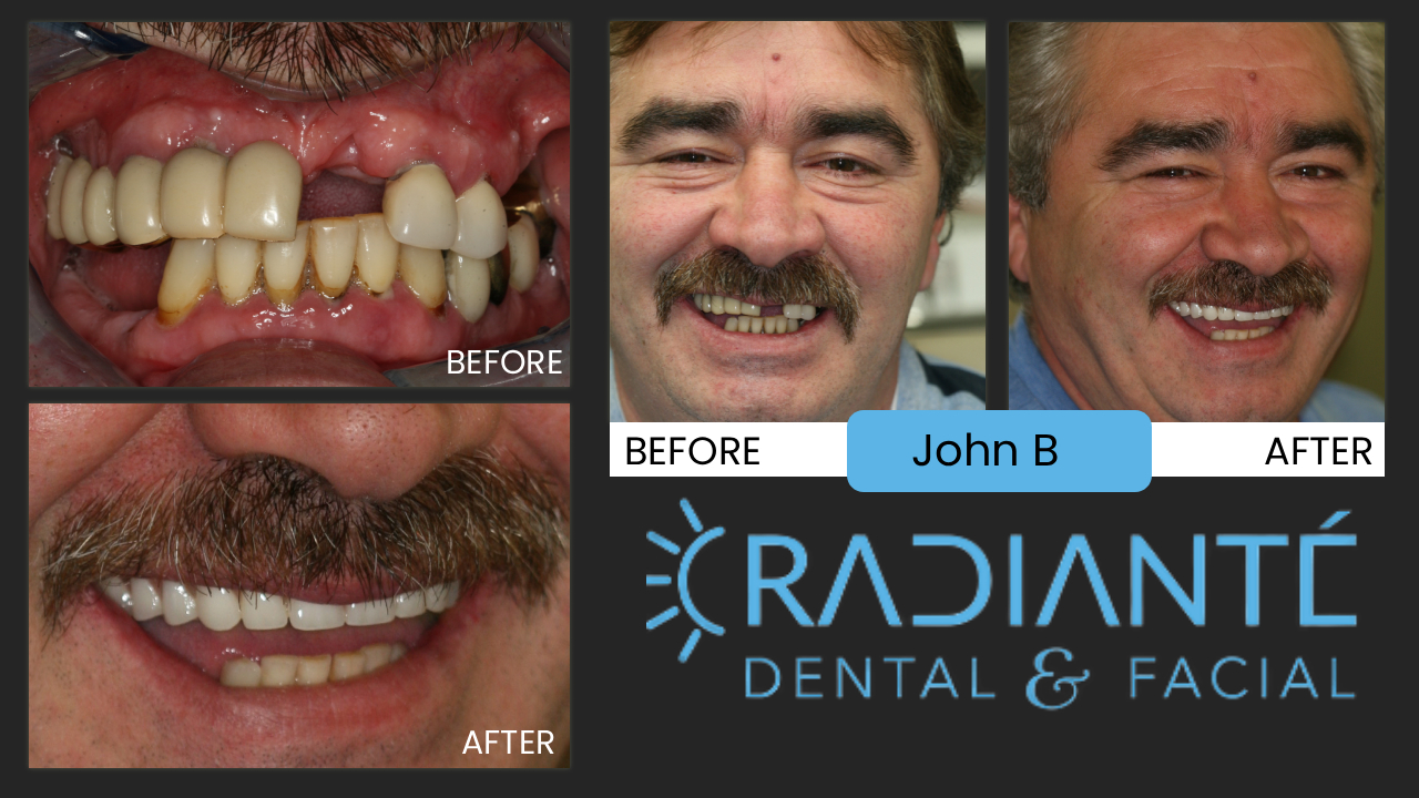 John was referred to us by a fellow plumber named John as well. John #1 is a very interesting and successful professional.  He is a collector.  He has a vintage Porsche sports car, he is a wine afficianado, and has a successful real estate portfolio.  He felt "people think plumbers are uneducated and dumb," and don't give them recognition for the accomplished professionals they are.  So John #1 got his teeth "done" so he would look more like the successful businessman that he is.  He then refers his fellow professionals to us to improve their looks to improve the image of his profession as a whole.  So John #2 came in and we gave him a smile to be proud of.  The only problem, which is not really a problem but a success, John #2 then became  more successful and branched off and started his own plumbing business!  Great success!