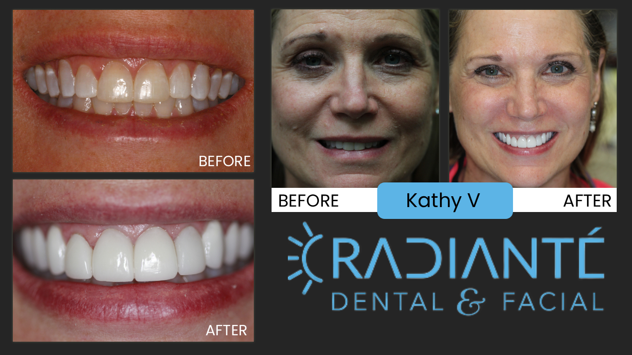Our own Kathy who had the greatest looking smile and teeth for the longest time, alas, it was time to give her a fresh look.  After 
attending the wedding of one of our clients, she looked at the photos of the bride and her together and said it's not fair our clients
have nicer teeth than me!  She was of course absolutely right. She had wanted veneers for a long time, but being always very conservative
Dr. Ivan always felt Kathy's teeth were very attractive and didn't want to mess with a good thing. He now agreed with Kathy. This is
on the day of delivery. Later we did her photoshoot of course. A beautiful woman like Kathy deserved a smile to match!