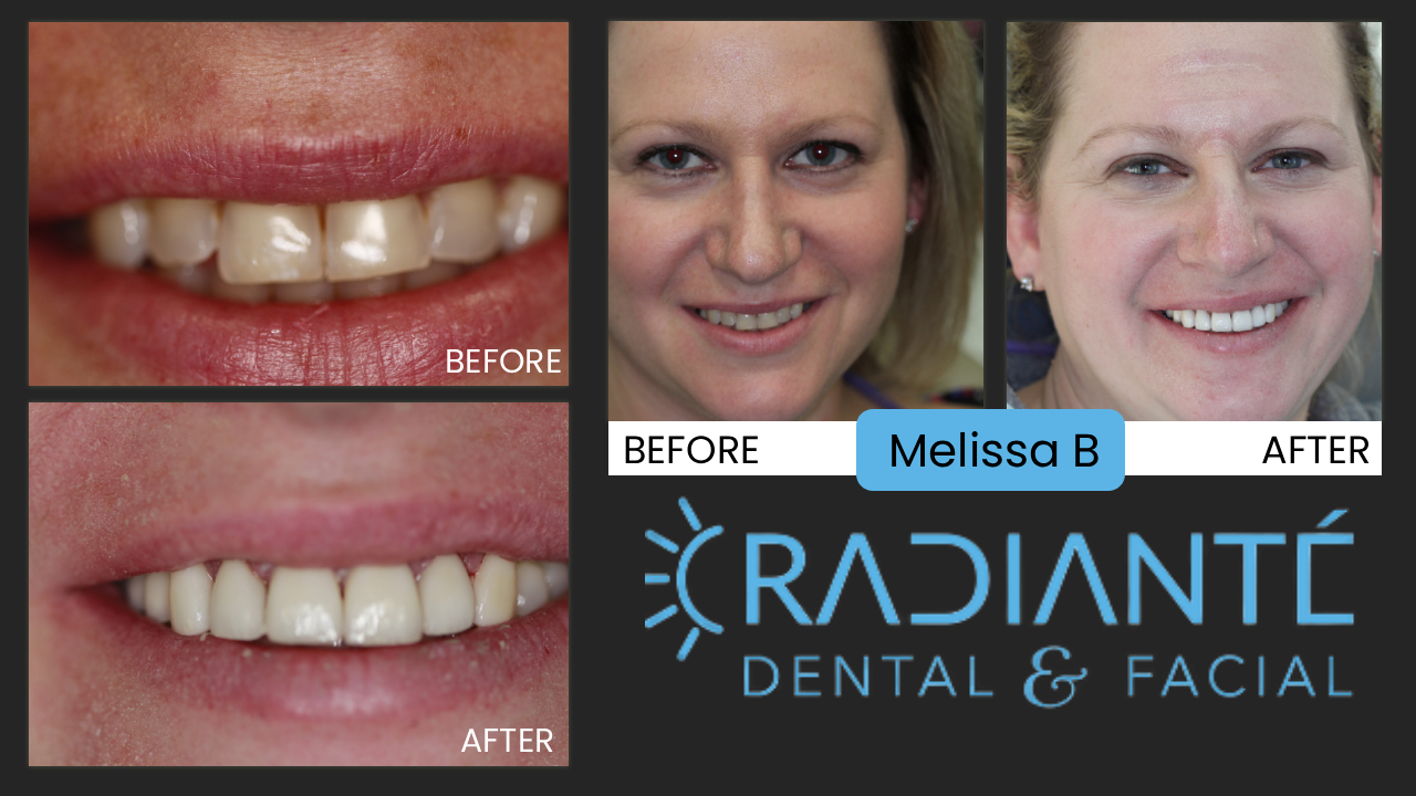 Melissa came to us two years earlier for a consultation about her smile which was neither healthy nor attractive.  She would cover
her mouth when she would smile or laugh and was embarassed by the condition her teeth and smile. Waiting two years is not unusual. Lots of people can take a couple of years before
theyvmake the decision to do something about their health and smile and Melissa was super motivated when she came back in.  And thank
goodness for that because a full mouth rehab is difficult to begin with, and in conjunction with dental implants which can take 6 months alone, it was quite a journey to get to
the beautiful and confident smile she now has achieved. Congrats Melissa, your smile is as beautiful as you are!