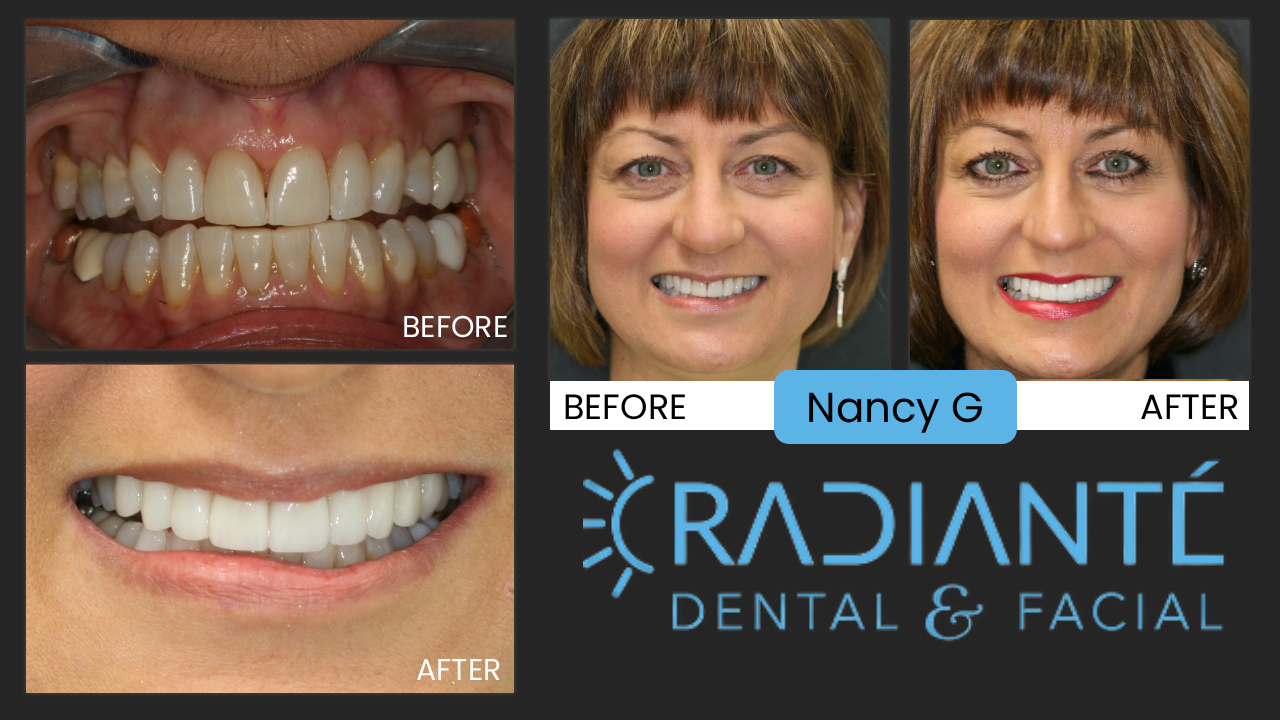 Nancy wanted to take the edge off aging. Nancy's smile looked okay, but okay is not good enough for an attractive lady like Nancy and in her line of work. As a consultant to some of the most advanced cosmetic dentists in the country, Nanci wanted a smile that was healthy and attractive, but she also had some design concerns because she has seen so many smile makeovers she didn't like. 
What we Found: A Great Foundation of Healthy teeth.
What we did: 10 veneers, Beautifully natural that fits Color, shape
and balance. 
"Not one dentist at our training seminar knew I got my teeth done!  That's why I chose you Ivan!  I love my smile.  It looks great, yet beautifully natural! "  --Nanci (Blatchford Solutions)