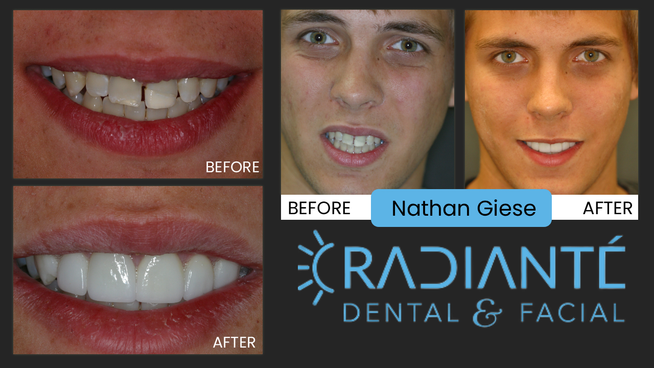 Nathan is a very quiet young man who came to us to improve his smile since he was going out to L.A. to seek his career in acting.  As you can see, his teeth were very gray, had a gap between his front teeth and had one tooth that was broken and poorly repaired.  The grayness of his teeth is due to either environmental or congenital problems and were not expected to ever whiten or improve.
So we chose to perform veneer treatment and give him a "wow" smile so he could get the better acting jobs and stand out amongst the crowd.
If you don't know the power of a great smile, allow me to point out that 7 of the last 8 best actress Oscar winners, all had cosmetic dentistry.  Of course they are great actors, but the having a great smile can make all the difference in gaining a coveted role or job.  Studies have shown the subconscious positive messages someone with nicer teeth have on others.  Things such as approachability, confidence, security, genuineness, honesty, all can be conveyed by the condition of your teeth and appearance of your smile.
As a side note to this, on the golf course most guys find out within a few holes what you do for a living.  I have taken to saying that I help people have more confidence, because this is exactly what people ask from me when they want their smiles to look better.  What is confidence worth?  Especially in the esteem of a young man or woman?  What path might someone have taken if they felt more accepted?
This is what drives us to help young people like Nathan!  After we got done, he admitted that it was his mom that wanted him to act, but that he liked directing better!  No matter, we know you'll be a huge success, Nathan!