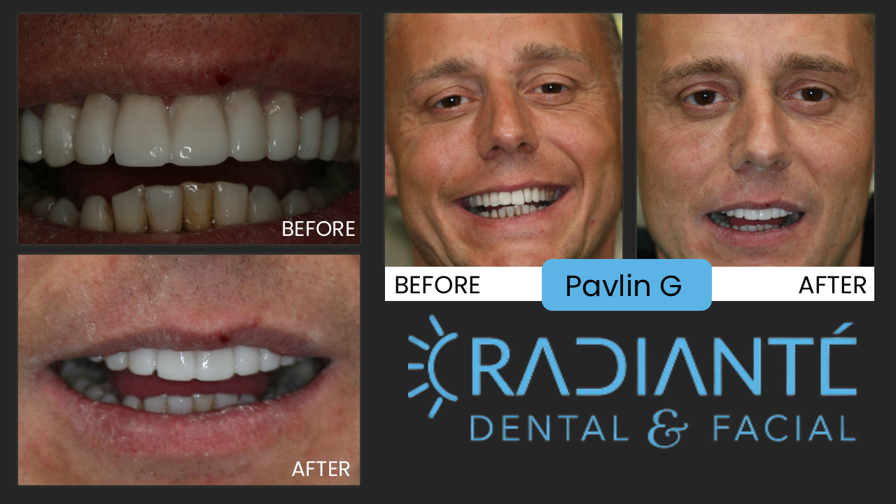 Pavlin is the penultimate man's man.  He is extremely successuful with a great business, a gorgeous wife, and beautiful family. He is super fit,
loves his Aventador, cares about the way he looks, dresses and manicured to the nth degree.  But one thing just didn't fit his image...his smile.
So after Stella his gorgeous wife got a smile makeover to match, he decided it was time his smile matched his impecable image. Every guy would
love to be in his shoes!