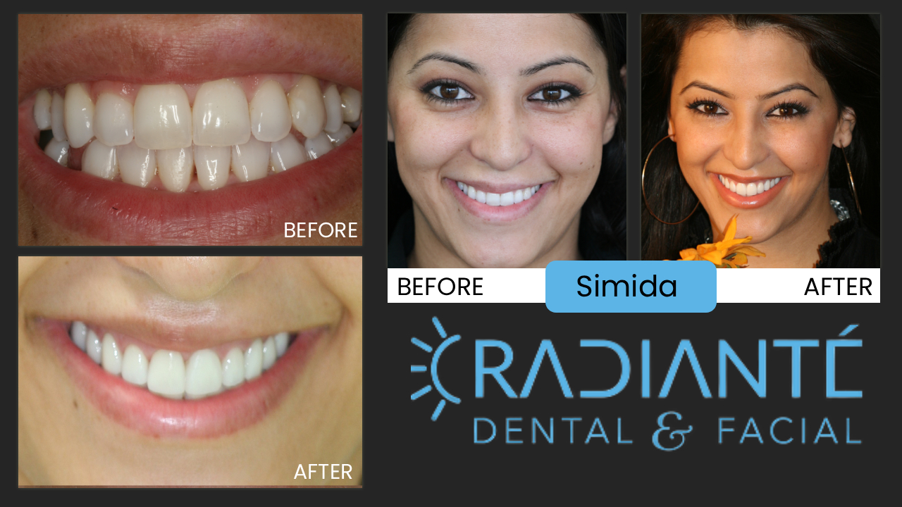 Thanks so much for the beautiful smile!! It is the greatest thing! I tell all my friends about you, but nobody has the money it seems even thou many need HELP :)) I'm still hoping that my cousin from Vegas will decide to do her smile. She is very beautiful and that's why I keep pushing her! You are the only doctor I recommended.
Simida already had a great smile, but she wanted one that lit up a room.  Simida is an interior designer and her eye for art is very descriminating, working with some of the most prominant builders in downtown Chicago. She also knew exactly what she wanted in her smile design, having purchased a smile design book, and bringing many photos to her consultation. 
What We Found: Simida had taken a traditional route of orthodontics, but after a year her teeth had drifted and moved. She wanted a more dependable and better results. 
What we Did: The Whitest Smile Yet. WOW!
Simida was a natural in front of the camera.  Normally we get only a handful of photos we like in a shoot.  We loved over 75% of her photos!  That's a record. 
What a beautiful smile for a remarkable and beautiful lady.  "That's why I chose you, Dr. Ivan...I knew you could give me what I wanted.  I love my smile!  I will refer everyone to you!"  Simida
It is my pleasure, Simida.  You are an amazing lady!