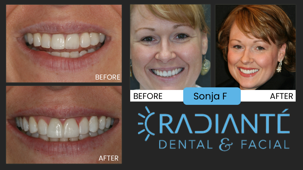 Sonja's story is an example that not all dentists who claim to do cosmetic dentistry, are the same. Sonja worked for a very good dentist on the East Coast, with a the committment to continuing education. Training is great, however, you need an understanding about materials, chroma, translucency, show through, design, and function. All the details that impact the results.
What we Found: Look closely at the "before" photos, Sonja looks okay, however, something is off with the position, and the teeth seem grayish in color. We discovered leakage and a bad smell around the new front teeth. Sonja was experiencing some bite problems and pain. This is a good example of how a dentist cannot just put a veneer and a new crown on front teeth without first understanding materials and the correct bite of the patient. There should not be pain or a smell after treatment.
What we did: New beautifully balanced porcelain restorations on her front teeth. We also did a variety of supportive procedures as well, including Gentle  Gum and tooth reshapinging to balance and soften the surrounding smile, Composite bonding  to lenghten and keep healthy tooth structure. 
"This is Me. Thank you. I want to retake my wedding pictures now." Sonja
The results:  Harmony: in color, in shape. A Fabulous Smile.