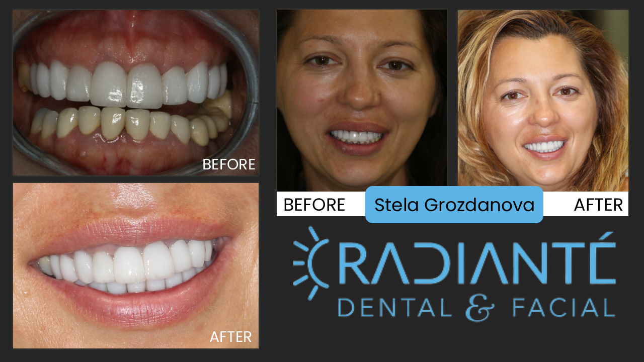 "I feel like a Hollywood star!"  Thank you so much for my beautiful smile.  I finally have the smile I want.  At Easter my whole family loved my smile and I had to give them all your phone number and address!"
Stela is a tall beautiful woman with kids now, but at one time she was a runway model.
Like many from Eastern Europe, however, she didn't have the nicest looking smile.
With a lot of unsightly old crowns that didn't do a good job of covering up the extensive dentistry under them.
So Stela had darkness around the margins of her crowns and small ill-formed teeth.
Stela has a lot of smile too showing a lot of teeth.  So we had our challenges to help her achieve a great smile.
We removed all the old dentistry, reconstructed her smile line with a gum lift and gave her new crowns
which were newer and whiter dental restorations that complimented her beauty rather than distracted from it.