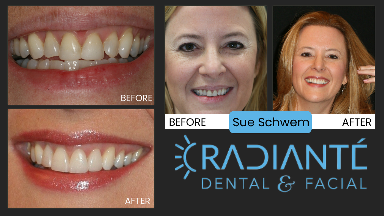Sue represents a very special situation, She has involved in a terrible fall and her smile was almost irrepareably damaged. Once the healing starts, the journey starts to find a place that gives you back your smile. What kept her going? Her brother said "You'll come out of this with an even better smile then you had before."
What we Found: Several front teeth cracked right off. After emergency treatment  and stabilization on her vacation, Sue tentatively reached out to Dr. Ivan after a reecommendation from a friend. Sue had discovered what many others had found out before- unless your dentist spends alot of time rebuilding smiles, you can't count on the results. Her teeth felt "shaky" when biting her food. 
What we Did: Gum Lift, ReShape, Whiten and design A wonderful Smile.
The gum lift is gentle and easy and creates the proportion for shape and size. The All porcelain restorations are natural and strong.
Now, Sue can't stop smiling and neither can we.