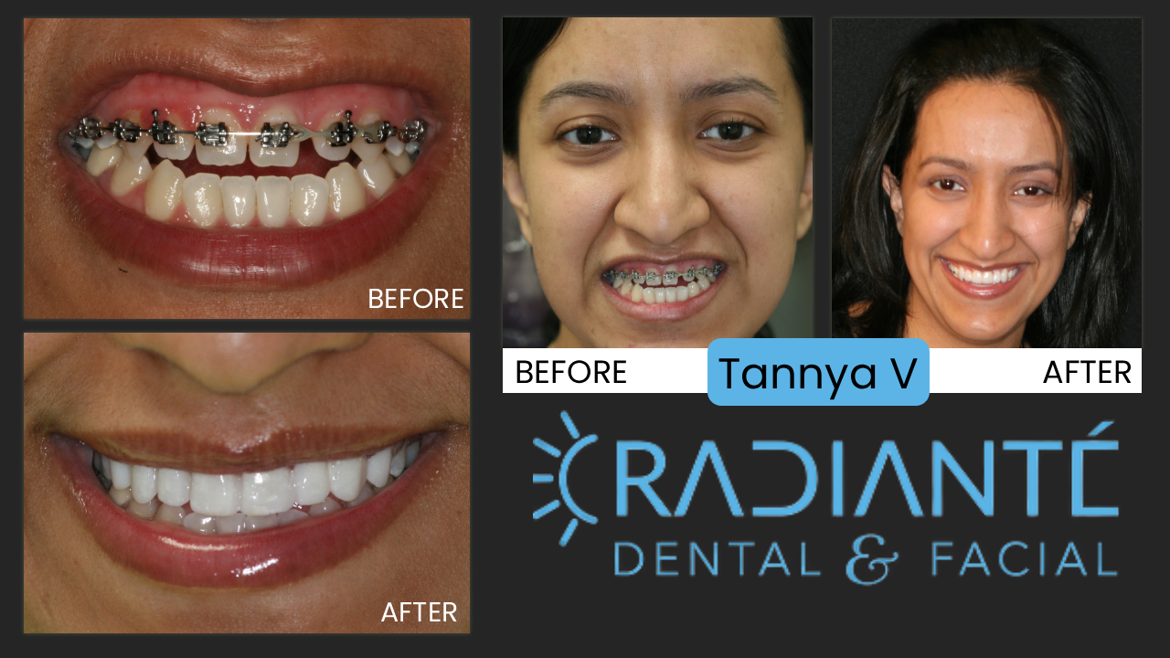 Tannya's story begins like so many.  She was actually accompanying her sister who had come to our office to improve her smile.  Perhaps because of all the photos displayed in our office, she realized her smile did not represent her as she would like. As a finance person in a bank, Tannya needed to look the part of a successful banker.  She felt her teeth did not allow her to look as presentable and professional as she needed. 
What we Found: Tannya started with  traditional orthodontic treatment, but became disenchanted as treatment was not improving her smile. She had an Open bite where the teeth did not touch when closed together. 
Her small, unnoticeable teeth that where becoming straighter but not . This is why we recommend seeing a cosmetic dentist prior to ANY treatment. Dr. Ivan can determine if your smile has the same problems Tannya's did when she undertook time-consuming treatment that would not give the results of an attractive smile.
What we Did: We needed to create more even spaces in her front teeth, so we worked until the spaces were more evenly distributed.  Then, a gum lift and beautiful porcelain veneers. This is the right treatment for Tannya to restore the fullness of her smile, the correct proportion in the tooth size and closed her open bite. 
The results are phenomenal.  Traditional orthodontic treatment, or surgery to correct her underbite would have been unnecessary pain and suffering and would have still left her with undersized teeth.  A cosmetic dentist is the right dentist to help Tannya have the smile of her dreams!She looks like the professional person that she is.