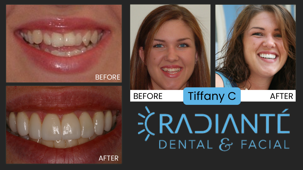 Tiffany was a young lady who was told all her life she would need surgery to correct her appearance and underbite. Not True.  Dr. Ivan and Dr. Voss pioneered a non-surgical, dental solution for Elizabeth a year before, and now Tiffany would be the beneficiary of this innovative approach. Tiffany had lots of crowded upper teeth, and we had to uncrowd them to see what space we had left to accomplish our goals, so she did traditional orthodontic treatment to move her front teeth into a better position and we discovered afterwards, we could place veneers that would just light up her smile for her upcoming wedding. Another non-surgical underbite correction with Cosmetic & Neuromuscular treatment.