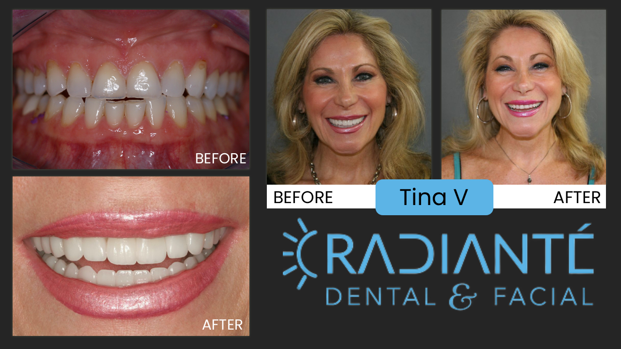 When you spent a lifetime gaining working on your career, your education, starting your own business and arrive at a certain age where you took care of your family, and built your business to a successful level, and now want to concentrate on catching up taking care of yourself, your mental and physical health. Now you have enjoyed the fruits of your work and can have most anything you want Successful businesswomen like Tina want to remove the years of stress on their minds, bodies, skin, faces, and smiles. They want to take their feet off the gas pedel and ease up, rejuvenate, and enjoy a career that allowed you to  enjoy and indulge yourself now. Most often we want to reduce stress, and it's affects on our health, bodies, faces and smiles. Look at Tina's before and after photos. Can you see the reduction in stress on her face and particularly around her eyes? This is what Cosmetic & Neuromuscular Dentistry is all about. Let's face it, a successful career comes with a lot of stress and it can wear on you and your teeth and jaws. Like a lot of people, this is what was evident in Tina. Neuromuscular Dentistry allowed her to look fresher, more relaxed, feel better, and gave her a new smile that accurately reflects how great she looks and now feels.