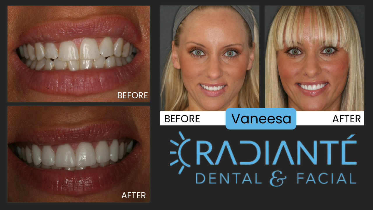 Vanessa tried to keep her teeth looking their best by whitening and regular visits to her dentist,  but her smile just didn't match her persona.   What We Found: Slightly turned and chipped teeth.  What we Did: Veneers for immediate, long-lasting, dramatic results.   Straighterand whiter. WOW!!She has the vibrant smile she's always dreamed of.    "I wanted a gorgeous smile and now I have it!  I can't thank you and your team enough.  Thank you, Dr. Ivan!"  Vanessa