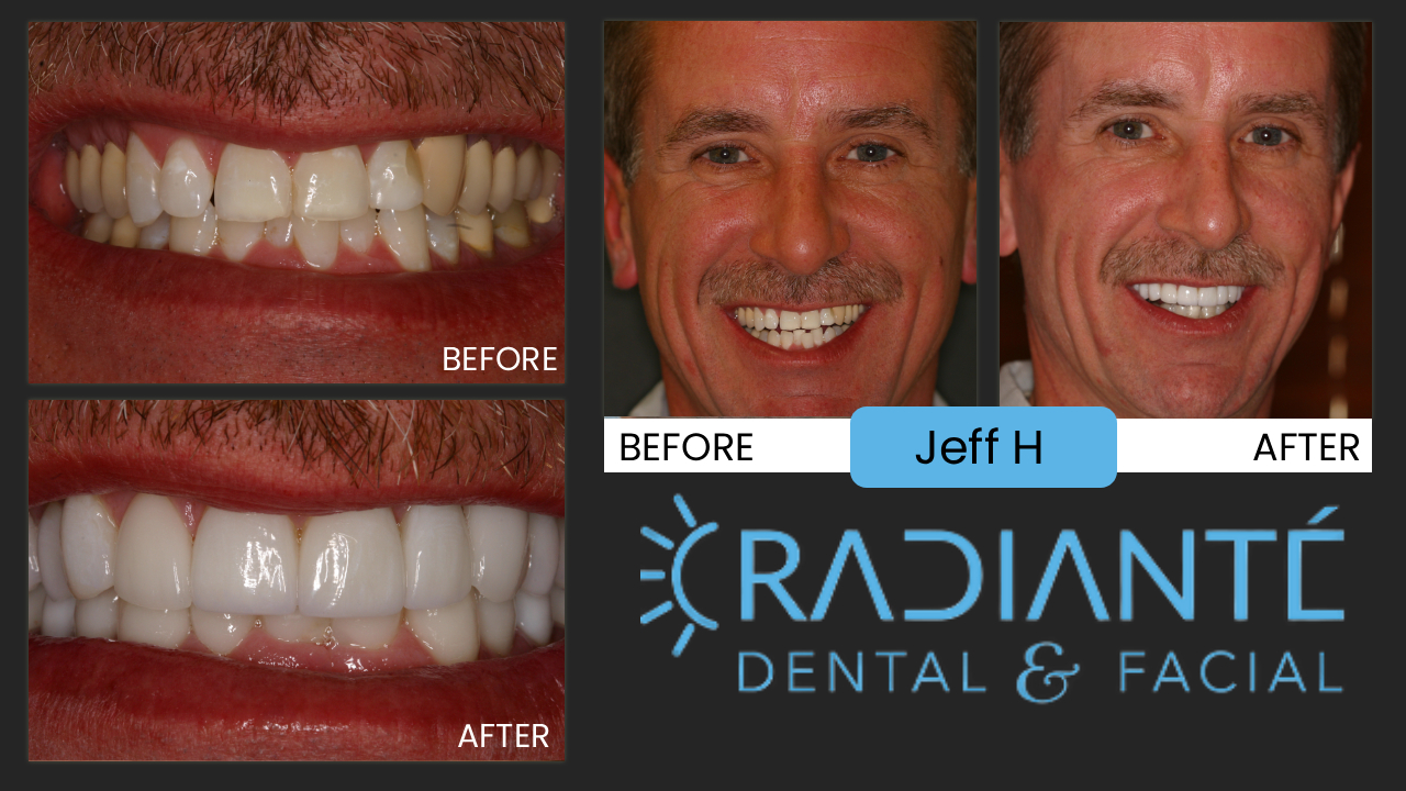 Jeff's story is not unlike a lot of people having divorced and looking for something that will make you look and feel
your best when entering the dating world again and there's nothing like a successful guy that looks the part with a
really nice smile and younger looking whiter teeth!