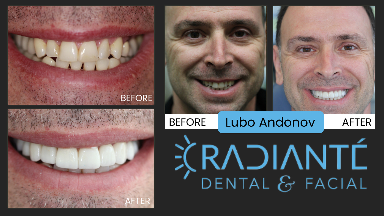 Lubo is a successful businessman and always felt a bit selfconscious of his less-than-perfect smile, but like a lot 
of people, he thought you had to live with what you had.  And even though his wife had been a clinical assistent to
several dentists, it was not until she came to work at Radiante' and discovered the art and beauty and confidence 
Cosmetic Dentistry and Facial Esthetics can provide patients, did she realize what could be done for her own smile.
Following the exceptional beauty of her new smile design and makeover, now Lubo wanted his smile improved. And what
a great result! He told us what we have heard so many times, that he now feels more proud, attractive and confident
in a healthier, stronger, and attractive smile.