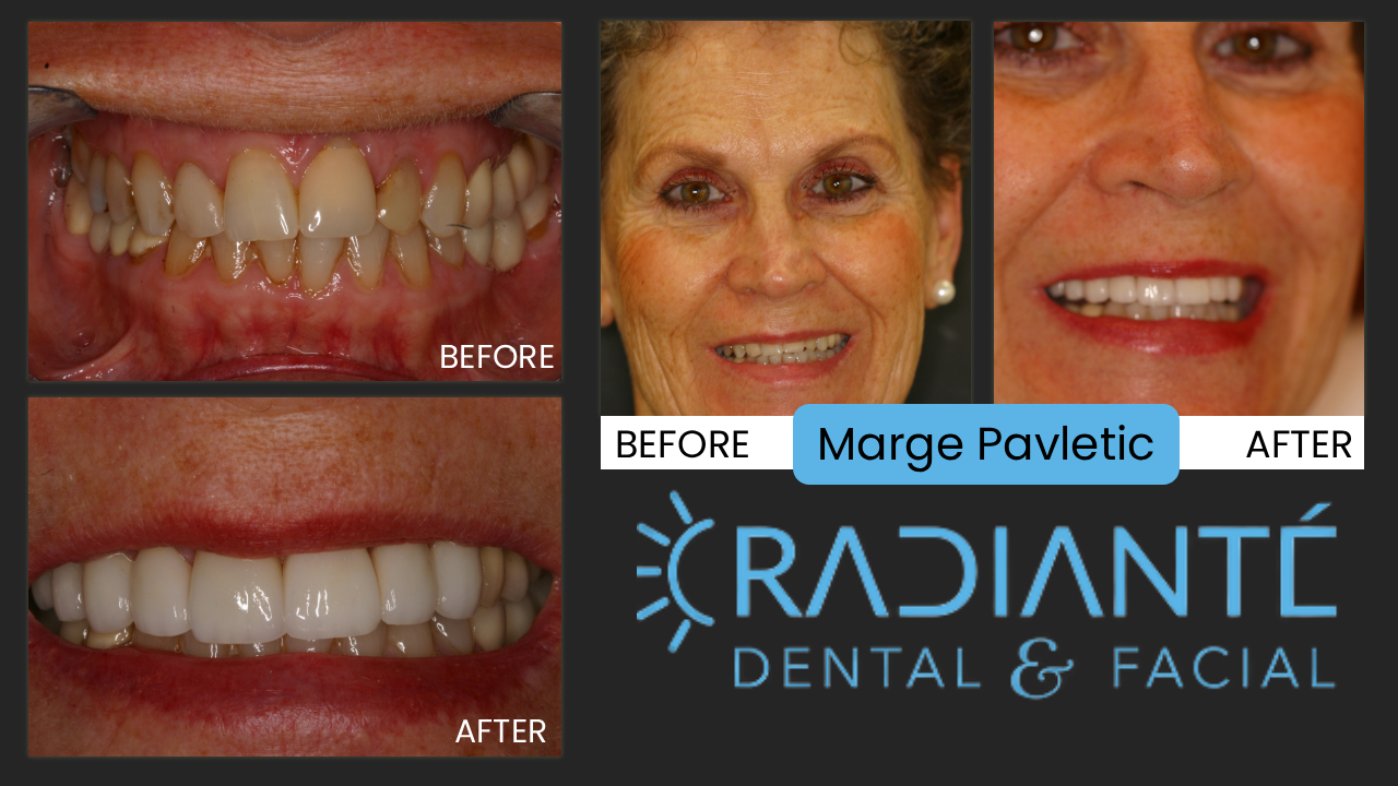 What she wanted:  I just adore Margi.  She's one of the kindest and nicest people you can ever meet.  Margi is beautiful and youthful.  She felt her smile was looking aged and worn.  Her loving husband of 50 years and three of her four children as dentists were all reticent to change her teeth.  This reluctance is natural, but Margi wanted it and so this loving family of dentists allowed Dr. Ivan to create a naturally beautiful smile.
What we did:  we paid particular attention to Margi's bite which placed abnormal pressures on her front teeth, and placed a variety of dental restorations, including crowns, and veneers on her front teeth to make them look newer and younger.
The results:  fantastic.  She has the smile which is the envy of her friends.  Her smile is more valuable than diamonds!  And thank goodness...Margi is my mother-in-law!!   Check our website to see the resemblance to our own beautiful, Dr. Kathy.