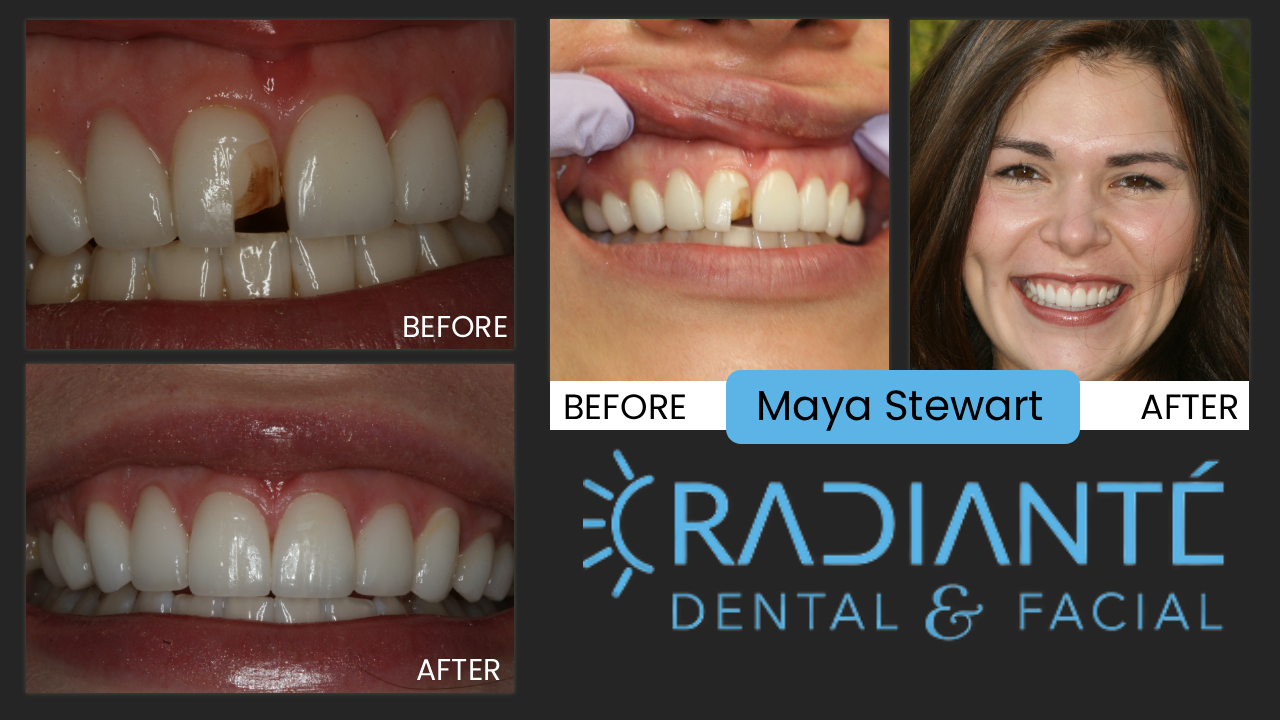 Maya had veneers done the year before but came to our office in tears that they just looked horrible.
Her veneers did not represent what she envisioned for her smile.  She wanted a beautifully natural looking smile but instead
got very lifeless, unnatural, angled improperly, and very opaque, dull veneers. Unfortunately not all dentists are highly
trained in the "golden proportion" in Cosmetic Dentistry and don't understand what materials and the type of dental materials
that should be used in particular and individual situations. Cosmetic Dentistry is difficult and takes time, training, skill,
and experience to do well. Maya now loves her smile and as a globetrekker, sometimes she will fly in from some exotic place just for us to check on her smile.