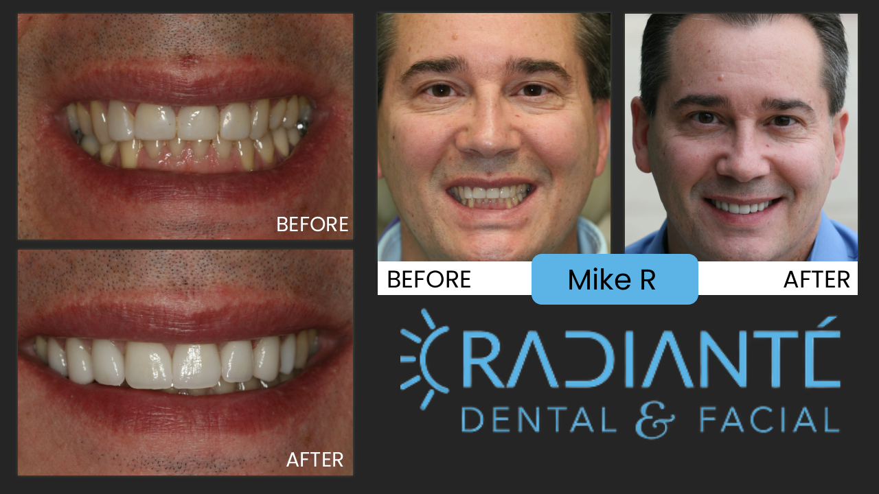 Mike had veneers on his teeth, but they were uneven, worn and his smile just wasn't beaming like it should.
Like we do with so many smile makeovers, we touched up his gums to make sure his smile was even and placed veneers
on all the teeth that were in his smile for a contiguous, even smile.  His confidence is soaring and loves his
Smile! "This is just what I was hoping for.  Thanks you do really good work, Dr. Ivan!"  Thank you, Mike!