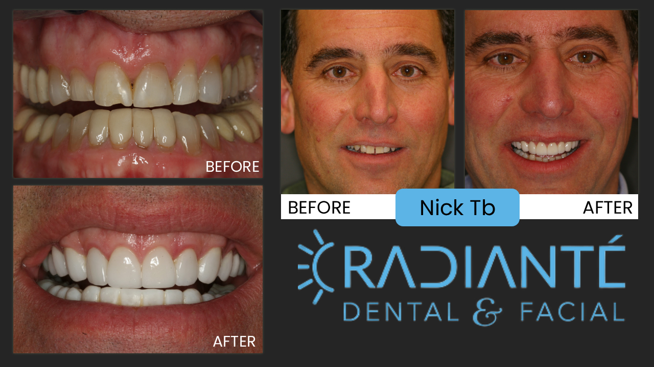 As a successful businessman, Nick felt his smile just wasn't giving him a successful image and confidence.
He was born with undersized teeth and clearly he needed to have a more profound smile that reflected
his success and confidence.  It is always amazing how a new smile will transform and personality, and 
Nick was no different.  Though he was always a very humble, super nice guy, his new smile made him more
sociable and less hesitant and reserved.  His personality just shined more as his smile did too.