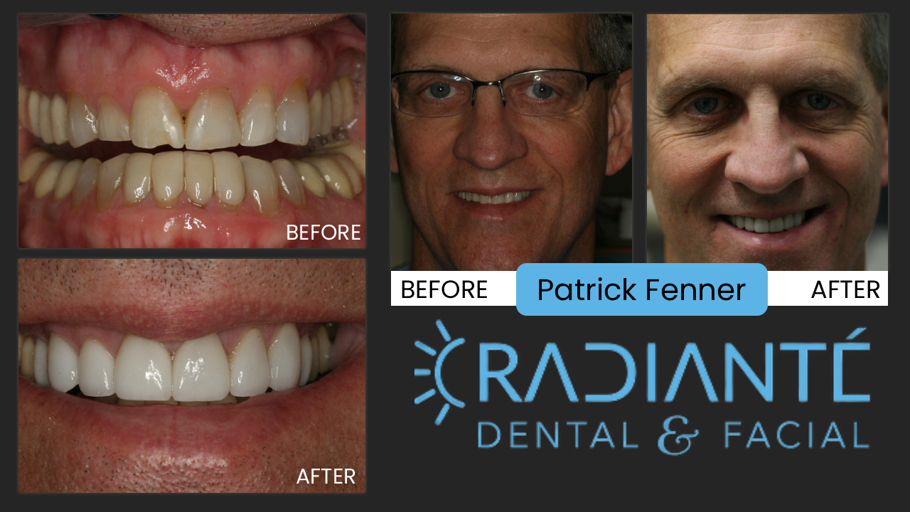 Patrick was referred to my by a another patient who has a terrible accident which left her in bad shape
and the rehabilitation that was done for her looked absolutely awful.  After a few years she started to look
for better solutions when she was referred to me by a colleague to see if I can rescue her smile.
The results turned out great which her bike-riding buddy, Patrick was pleasantly amazed and surprised at how
good we were able to improve her smile.  Patrick had small, discolored, chipped and worn teeth.  There are 
basically three things that will age you dramatically: poor skin, gray hair and aged, worn teeth. Aged and worn
teeth also have a way of looking unhealthy. Patrick is athletic, active and thin and with a young family,
didn't want to look older than he had to and as a health care professional, he should look healthy and good.
We did a mockup of what he could look like and then placed him with a provisional smile which he loved.
We then simply made veneers for his teeth and gave him a new, great-looking smile that makes him look years
younger and healthier.