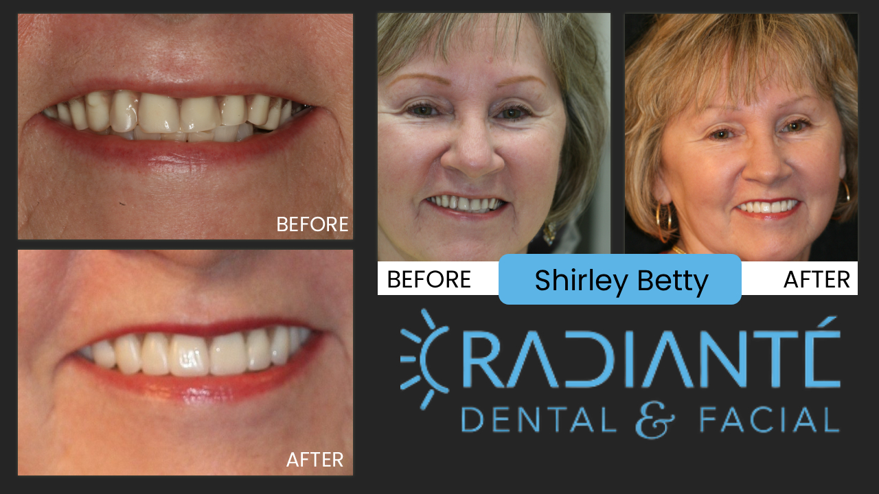 Shirley is a hip, with-it Grandma with a busy life with her husband, Roy, her daughter, granddaughter and dogs.
What We Found: A Smile that needs too many repairs to keep it going.
What We did: A new Smile- Freshened up. Whiter, Softer and healthy.
Confident and ageless beauty.  
Thanks Shirley, we loved helping you! Your zest for life comes through.