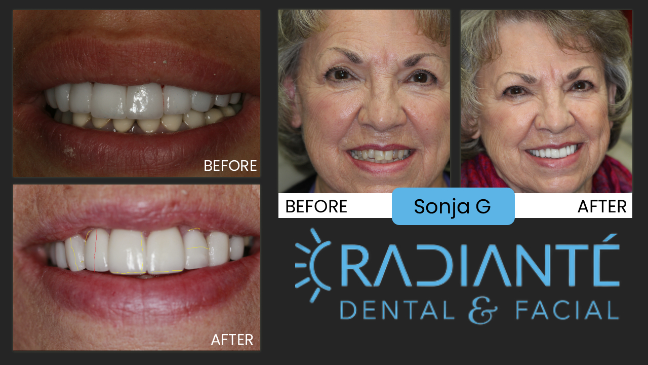 Now don't you think Sonja deserved this new smile? She reflects how beautiful and youthful you can be at any age!