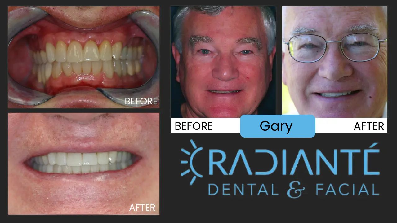 Gary is one of the nicest guys you would ever meet. Gary had a terrible clicking (actually clunking) in the jaws and headaches. He was hoping to find a solution to correct the jaws and was surprised that a solution could exist for his headaches. As a former aviation manager, he never had the time to do anything about the terrible popping and clicking in his jaws caused by the stress of work and years of clenching and grinding his teeth.  What We Found: Where are Gary's teeth when he smiles? Discolored worn out, mishmash of different types and colors of the teeth you can see. A cosmetic dentist will look at Gary as a whole,at the symmentry of Gary's face, you would notice that the lower one-third of Gary's face is far shorter than the middle or upper 1/3. His nose-to-chin ratio is very short. There is quite a lot of stress on the TMJ or jaw joints causing them to wear and degrade prematurely and could lead to disabling arthritis in the jaw joints.  This explains the terrible jaw noises when opening and closing.  What We Did: Because of Gary's bite and jaw issues, Full Mouth Rehabilitation was needed that would alleviate the pressure on his TMJ and jaws, improve his bite and give him newer, healthier, more uniform looking teeth as well as showing the teeth when he smiles.     A great side effect enjoyed here is jaws, TMJ and headaches gone anf gary is feeling great.   We are very happy to have helped Gary.  It's been several years and he's doing great and still racing cars!