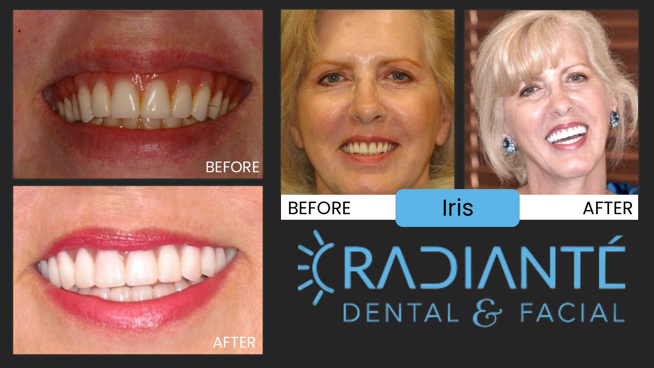 Iris is beautiful, but she just wasn't happy with the smile a dentist had recently made for her.  After listening to her desires, Dr. Ivan found that Iris was unhappy with how gummy her smile looked.  What Dr. Ivan found:  all too common in orthodontics as well, dentists try to align the upper and lower teeth together to make them look straight.  The problem is that Iris has an overbite and by aligning her upper and lower teeth together creates the gumminess.  As with most overbites, it's not the upper teeth that are the problem, it's the lower jaw that doesn't develop far enough forward.  What we did:  In creating this full mouth rehabilitation, Dr. Ivan first created the ideal upper teeth to where Iris was very excited about the aesthetics.  He then designed her lower teeth to meet this idealized look and voila!  An excited and beautiful smile for a beautiful woman!