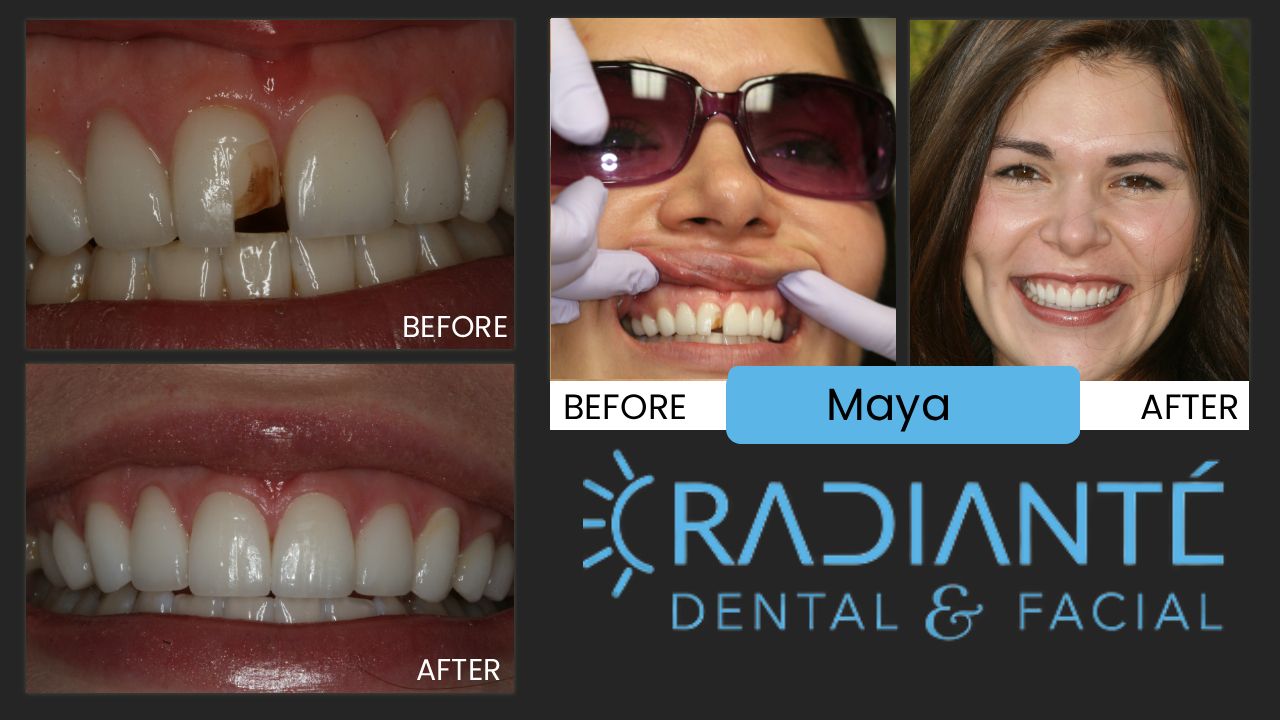 Maya had veneers done the year before but came to our office in tears that they just looked horrible.
Her veneers did not represent what she envisioned for her smile.  She wanted a beautifully natural looking smile but instead got very lifeless, unnatural, angled improperly, and very opaque, dull veneers. Unfortunately not all dentists are highly trained in the "golden proportion" in Cosmetic Dentistry and don't understand what materials and the type of dental materials
that should be used in particular and individual situations. Cosmetic Dentistry is difficult and takes time, training, skill,
and experience to do well. Maya now loves her smile and as a globetrekker, sometimes she will fly in from some exotic place just for us to check on her smile.