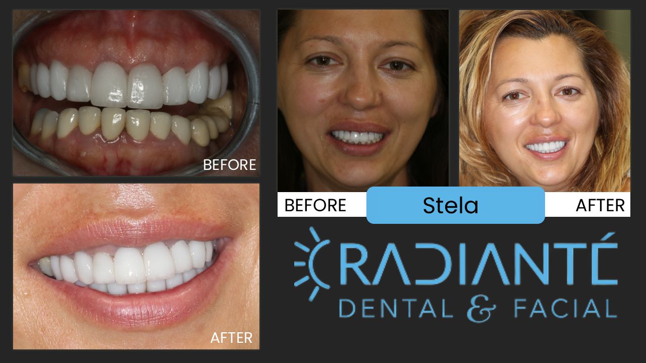"I feel like a Hollywood star!"  Thank you so much for my beautiful smile.  I finally have the smile I want.  At Easter my whole family loved my smile and I had to give them all your phone number and address!"

Stela is a tall beautiful woman with kids now, but at one time she was a runway model.
Like many from Eastern Europe, however, she didn't have the nicest looking smile.
With a lot of unsightly old crowns that didn't do a good job of covering up the extensive dentistry under them.
So Stela had darkness around the margins of her crowns and small ill-formed teeth.
Stela has a lot of smile too showing a lot of teeth.  So we had our challenges to help her achieve a great smile.
We removed all the old dentistry, reconstructed her smile line with a gum lift and gave her new crowns
which were newer and whiter dental restorations that complimented her beauty rather than distracted from it.