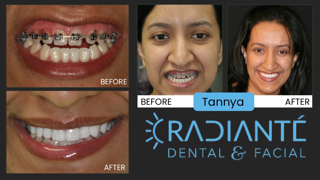 Tannya's story begins like so many.  She was actually accompanying her sister who had come to our office to improve her smile.  Perhaps because of all the photos displayed in our office, she realized her smile did not represent her as she would like. As a finance person in a bank, Tannya needed to look the part of a successful banker.  She felt her teeth did not allow her to look as presentable and professional as she needed.   What we Found: Tannya started with  traditional orthodontic treatment, but became disenchanted as treatment was not improving her smile. She had an Open bite where the teeth did not touch when closed together.  Her small, unnoticeable teeth that where becoming straighter but not . This is why we recommend seeing a cosmetic dentist prior to ANY treatment. Dr. Ivan can determine if your smile has the same problems Tannya's did when she undertook time-consuming treatment that would not give the results of an attractive smile.  What we Did: We needed to create more even spaces in her front teeth, so we worked until the spaces were more evenly distributed.  Then, a gum lift and beautiful porcelain veneers. This is the right treatment for Tannya to restore the fullness of her smile, the correct proportion in the tooth size and closed her open bite.   The results are phenomenal.  Traditional orthodontic treatment, or surgery to correct her underbite would have been unnecessary pain and suffering and would have still left her with undersized teeth.  A cosmetic dentist is the right dentist to help Tannya have the smile of her dreams!She looks like the professional person that she is.