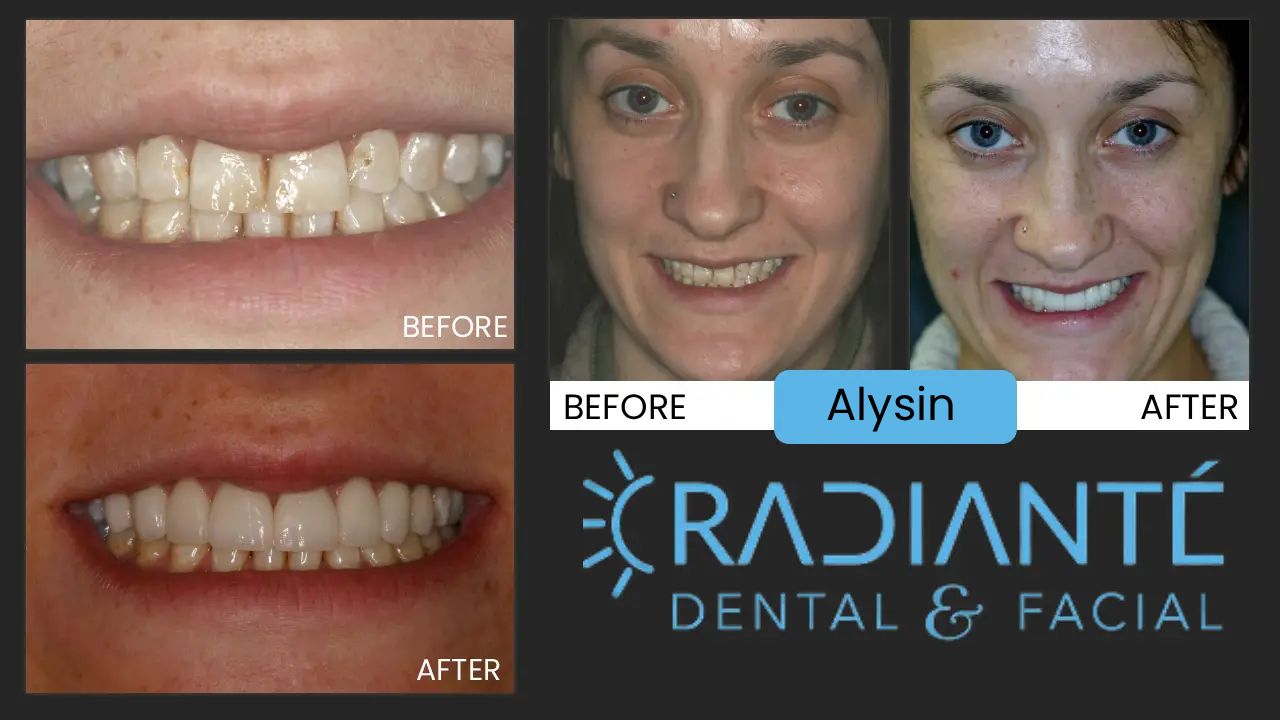 This is AlLyson.  She is very shy and was sooo nervous for her photoshoot, but doesn't she look fabulous!    What she wanted: To be able to Smile without covering her mouth. Allyson inherited mottled enamel in her teeth which is sometimes called "soft" teeth ,and results in frequent cavities .   We can perform treatment that actually protects her teeth and actually makes her teeth stronger, beautiful and natural.   What we did:  It looks simpler than it is, starting with eliminating the cavities. We got her working better at home and reviewing her diet.  We then removed all the damaged tooth structure , replaced and rebuilt her teeth. Her gums were then gently reshaped with laser gum surgery ,or a "Gum Lift" , which  makes a  more  balanced  and symmetric  smile. Finally, Veneers - creating the  beautiful , natural smile Allyson wanted to share with the world.  "What a difference it has made in my life!"  --Allyson M.--