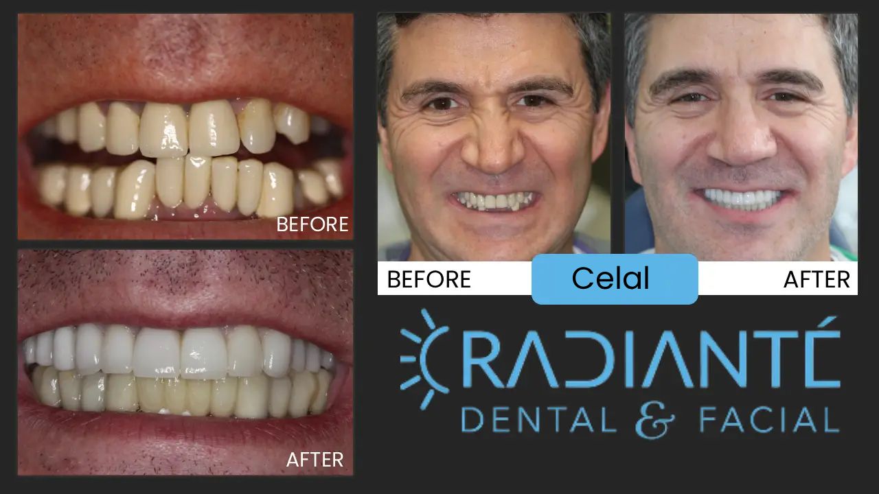 Celal came to us after years of struggling with severe jaw pain, headaches, fatigue, and unsuccessful treatments. Traditional approaches hadn’t given him lasting relief, but through neuromuscular dentistry, we found a more natural, conservative solution. Using a custom orthosis appliance, we eased the pressure on his jaw joints without drilling or irreversible treatment. The results were life-changing—his pain and fatigue diminished, sleep and chewing improved, and he finally regained his confidence. Along the way, we also treated his sleep apnea with an oral appliance, giving him not just a healthier smile but a healthier life. Today, Celal is pain-free, energized, and proud of his radiant new smile!