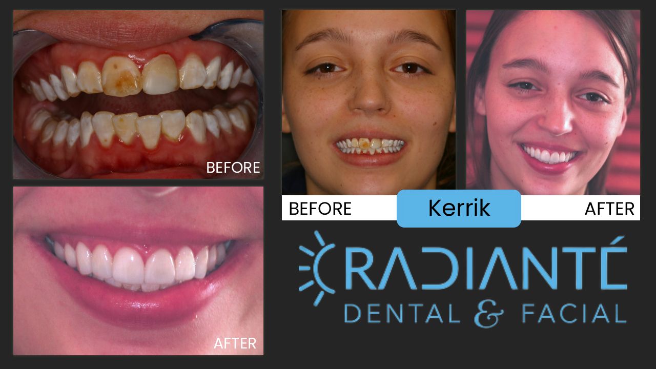 Kerri's story is heartbreaking and heartwarming at the same time.  From difficult, dysfunctional parents, Kerri's grandfather took on the mantle of making sure Kerri was on a better path in life and when he asked her what she wanted for her 18th  birthday and graduation gift from high school, without hesitation, she said "I want my teeth done." With lack of professional care imagine how aweful it would be for a young lady to have front teeth and a smile that is marred and unattractive.  You don't want to smile when your teeth look like the "before" photo.  Imagine how she felt. Imagine the teasing she received in middle school when kids can be a careless with their comments.  A few visits later, a young woman blossomed before our very eyes. You could see the transformative effect this made on her immediately.  Kerri is a huge success today having not only finished college, but also grad school, is a married mother of two and has left that horrible childhood far behind and has become a beautiful, successful wife and mother.  We are happy to have been a part of helping her look and feel her best, confident to go out in the world with perhaps her best asset representing how beautiful she truly is.