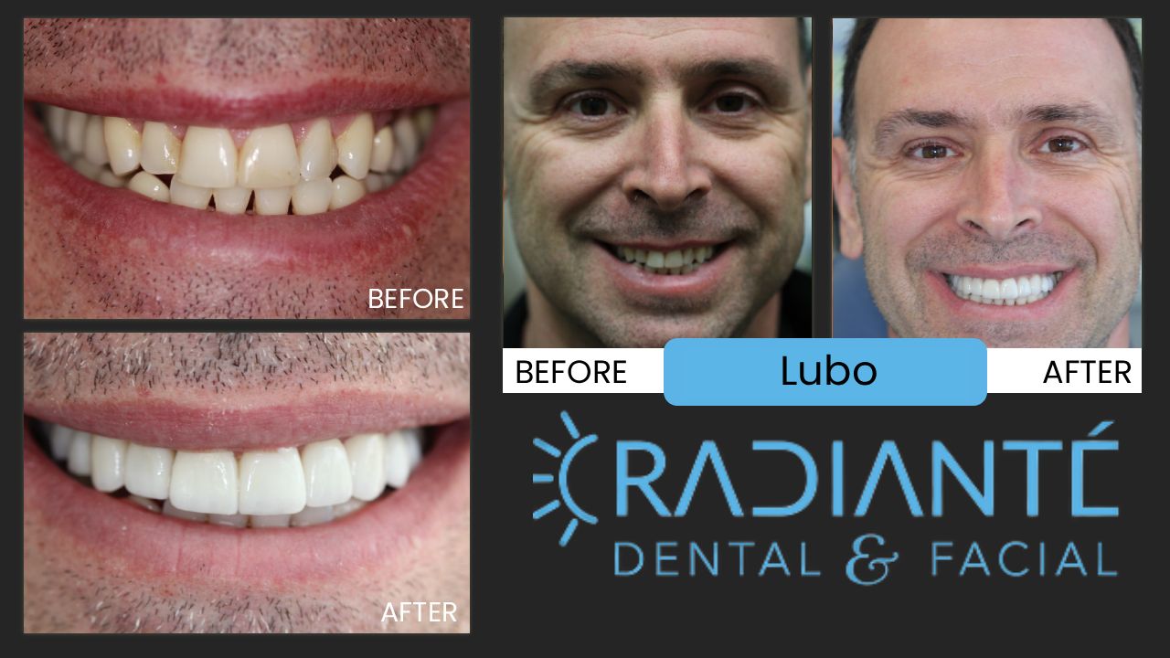 Lubo is a successful businessman and always felt a bit selfconscious of his less-than-perfect smile, but like a lot  of people, he thought you had to live with what you had.  And even though his wife had been a clinical assistent to several dentists, it was not until she came to work at Radiante' and discovered the art and beauty and confidence  Cosmetic Dentistry and Facial Esthetics can provide patients, did she realize what could be done for her own smile. Following the exceptional beauty of her new smile design and makeover, now Lubo wanted his smile improved. And what a great result! He told us what we have heard so many times, that he now feels more proud, attractive and confident in a healthier, stronger, and attractive smile.