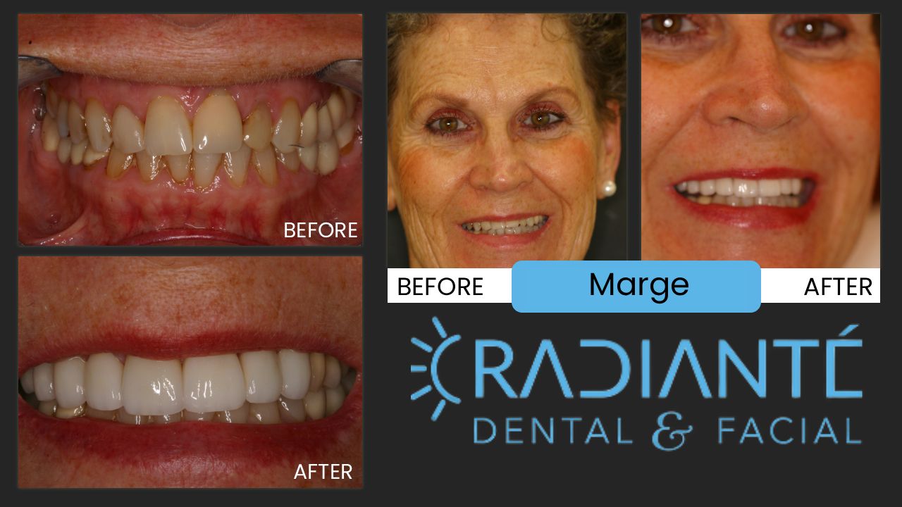 What she wanted:  I just adore Margi.  She's one of the kindest and nicest people you can ever meet.  Margi is beautiful and youthful.  She felt her smile was looking aged and worn.  Her loving husband of 50 years and three of her four children as dentists were all reticent to change her teeth.  This reluctance is natural, but Margi wanted it and so this loving family of dentists allowed Dr. Ivan to create a naturally beautiful smile.  What we did:  we paid particular attention to Margi's bite which placed abnormal pressures on her front teeth, and placed a variety of dental restorations, including crowns, and veneers on her front teeth to make them look newer and younger.  The results:  fantastic.  She has the smile which is the envy of her friends.  Her smile is more valuable than diamonds!  And thank goodness...Margi is my mother-in-law!!   Check our website to see the resemblance to our own beautiful, Dr. Kathy.